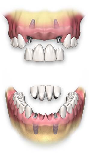 Protesi fisse per denti e chirurgia dentale - Centro Odontoiatrico Atena, Brindisi
